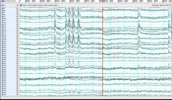 46 niños fueron diagnosticados de epilepsia en Soria durante en 2017
