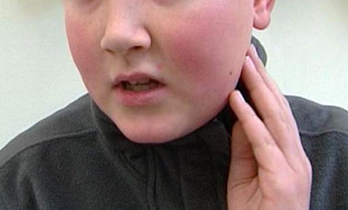 Un menor aquejado por paperas. 