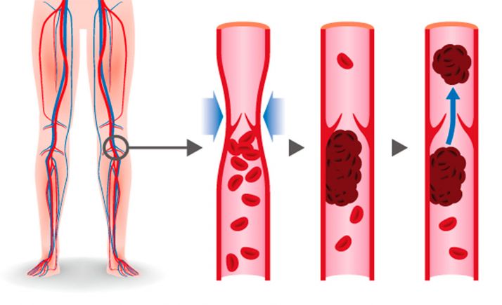 Uno de cada seis pacientes hospitalizados con COVID-19 ha sufrido eventos trombóticos