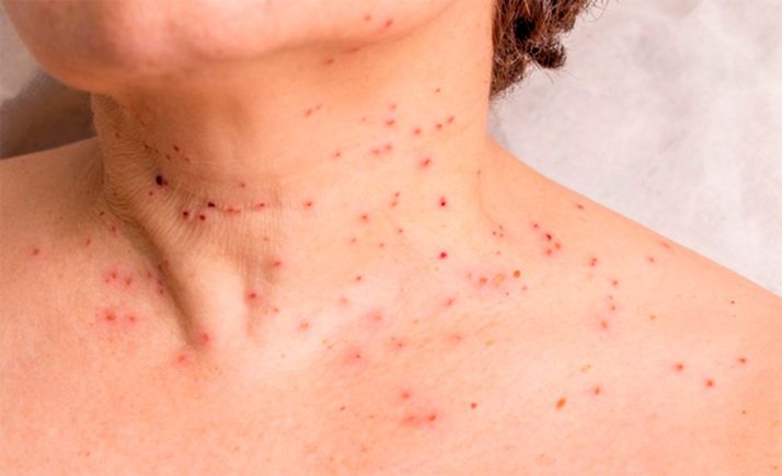 La Junta invertirá 1,2 M€ para adquirir vacunas contra el papiloma humano 