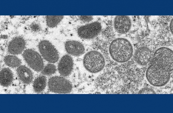 Castilla y León suma dos casos más de viruela del mono