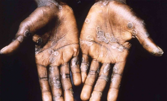 Detectados diez nuevos casos de viruela del mono en Castilla y León