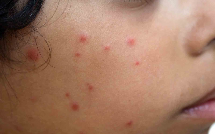 Castilla y León destina más de 5 M€ para vacunas frente al herpes zóster