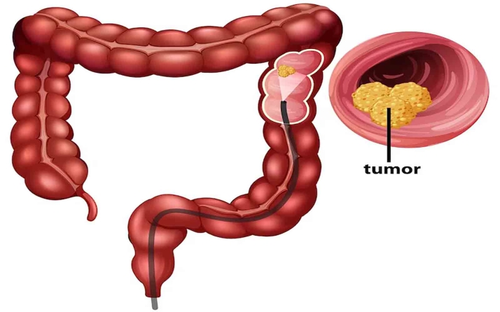 La tasa de participación de los sorianos para localizar el cáncer de colon, superior a la media de Castilla y León
