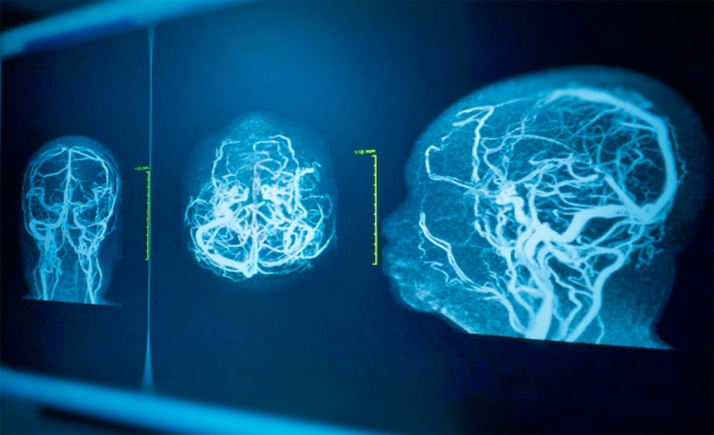 3 hospitales de Castilla y León, premiados por la Organización Europea del Ictus