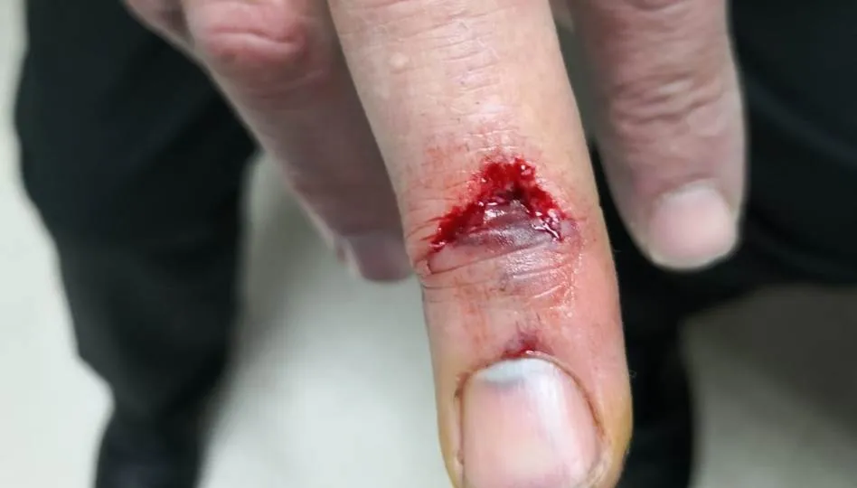 Herida del funcionario tras el mordisco de un interno en Topas