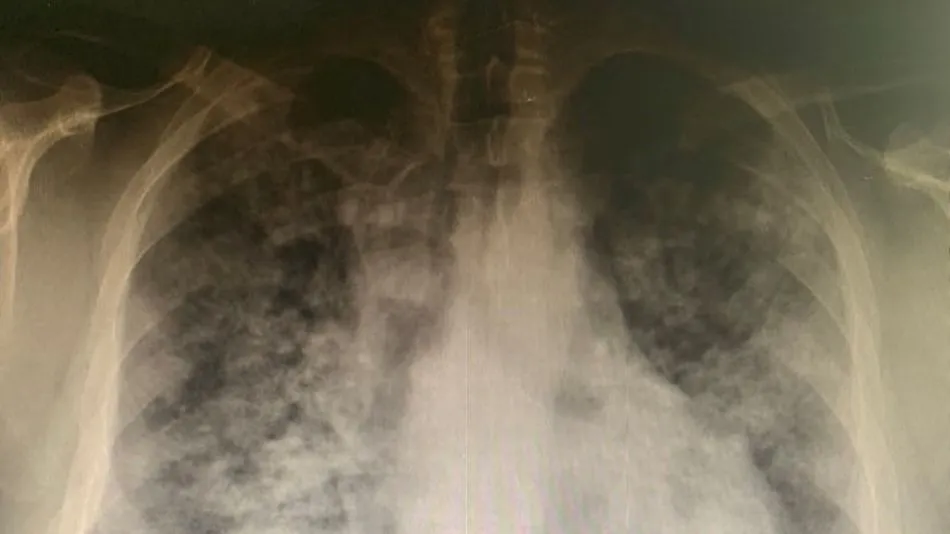 Radiografía real del paciente Manuel, compartida por Jorge Criado - Twitter @JorgeGCriado1