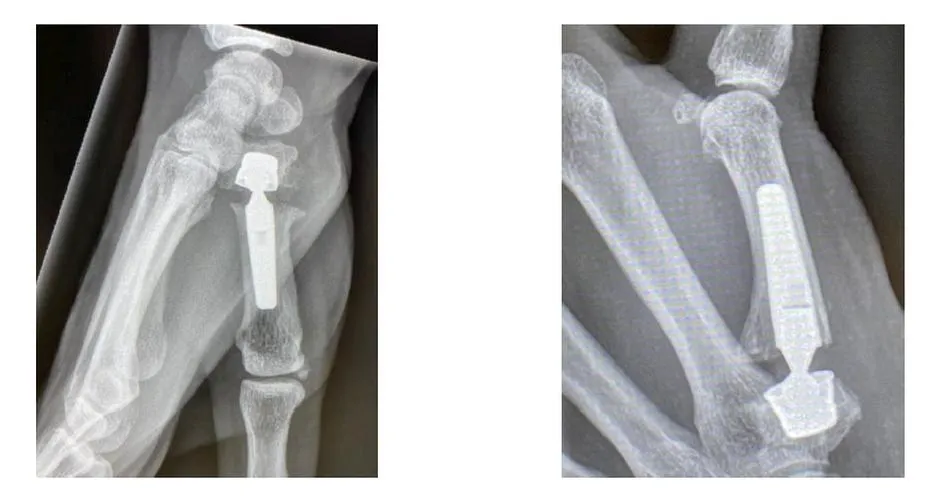 La artroplastia de la articulación trapecio metacarpiano es una intervención ambulatoria cada vez más demandada, en la que paciente recibe el alta el mismo día y cuyo tiempo de recuperación es menor