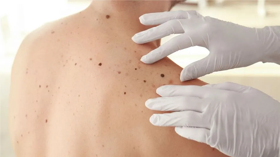 ¿Cuándo un lunar nos tiene que preocupar?