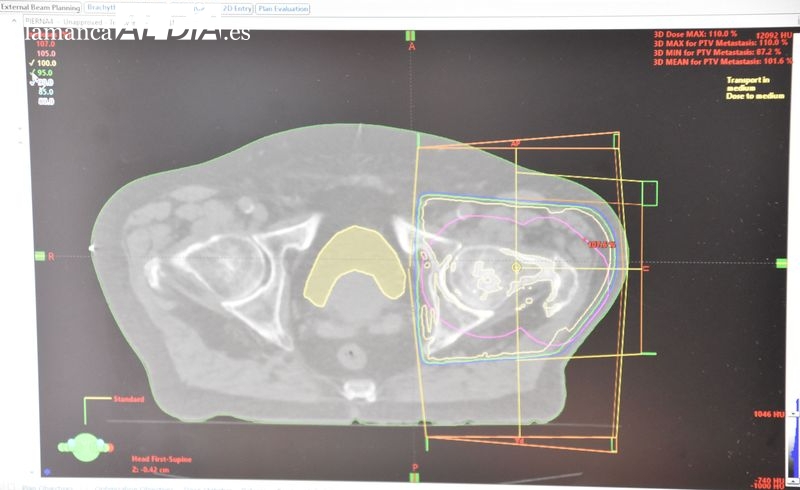 Nuestra misión es intentar irradiar lo que nos piden sin tocar los demás órganos