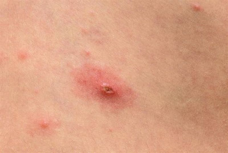 ¿Cuántos casos de viruela del mono hay confirmados en España? 