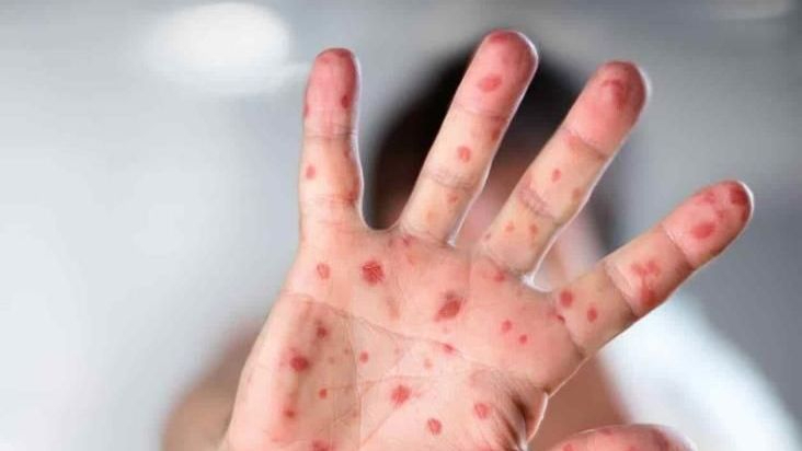 Los casos de viruela del mono en España: 800 confirmados, uno de ellos en un menor de 3 años 