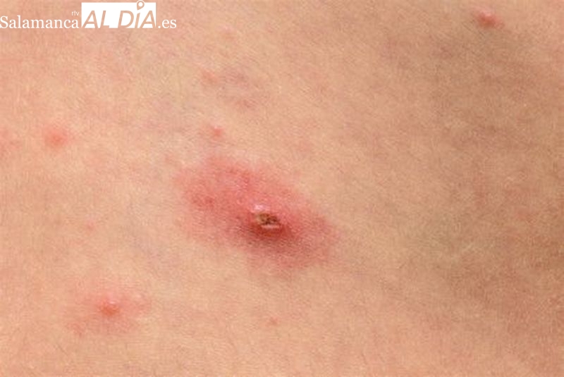 Nuevo posible caso de viruela del mono en Castilla y León