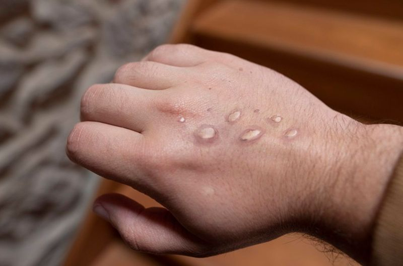 España roza los 1.200 casos confirmados de viruela del mono 