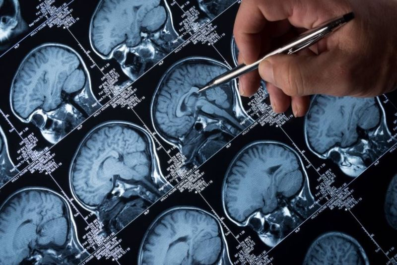 Un fármaco con sello español muestra eficacia ante el tumor cerebral más frecuente