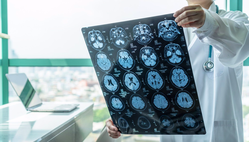 ¿Por qué reaparece la forma más mortífera de cáncer cerebral?