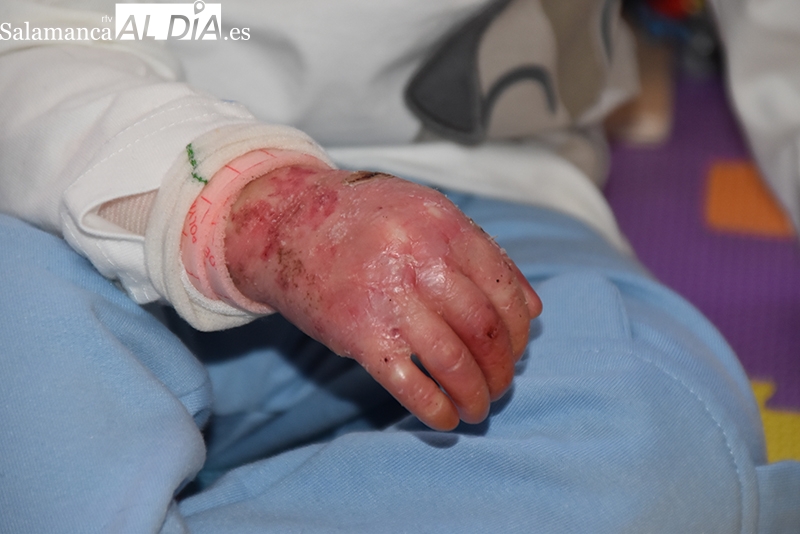 Piel de Mariposa, la enfermedad rara que condiciona a la persona desde su nacimiento