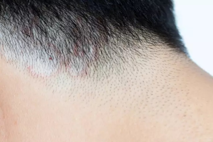 ¿Qué hacer para evitar que te afecte la tiña? Principales síntomas y tratamientos