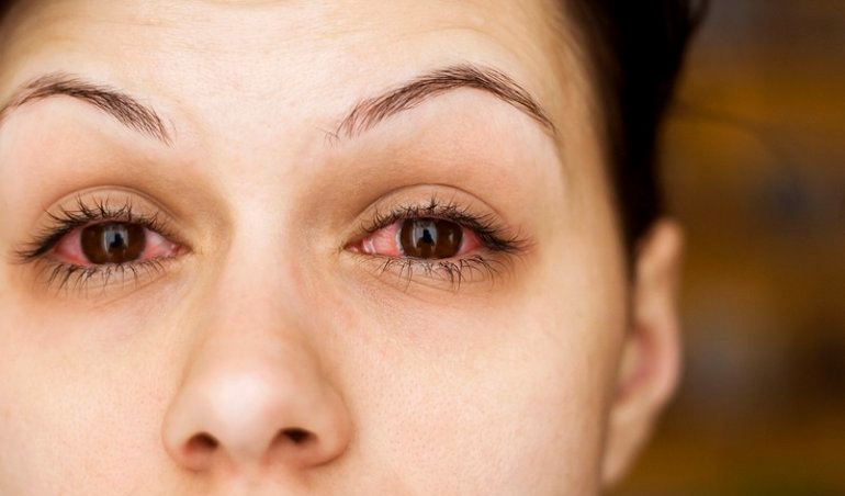Conjuntivitis: ¡cuidado con el mito de la manzanilla!
