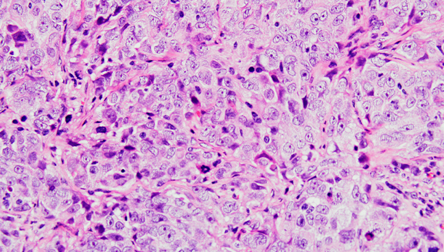 Identificada una vía molecular implicada en cáncer de ovario y en la generación de resistencias en esta enfermedad