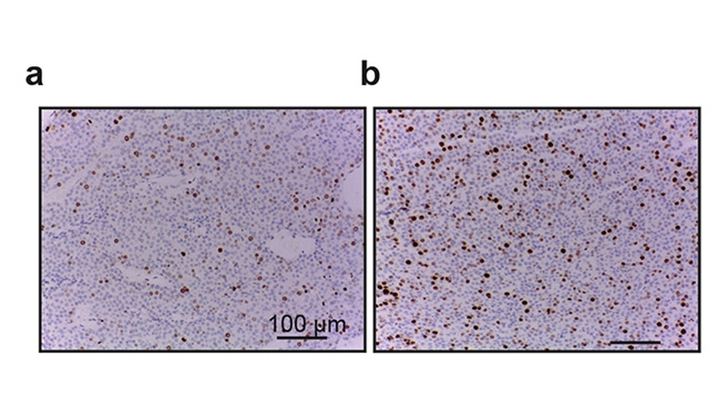 Demostrada la participación del gen NCAPH en el mal pronóstico y evolución de un cáncer de mama