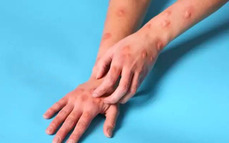 Sanidad registra 67 nuevos casos de viruela del mono en una semana