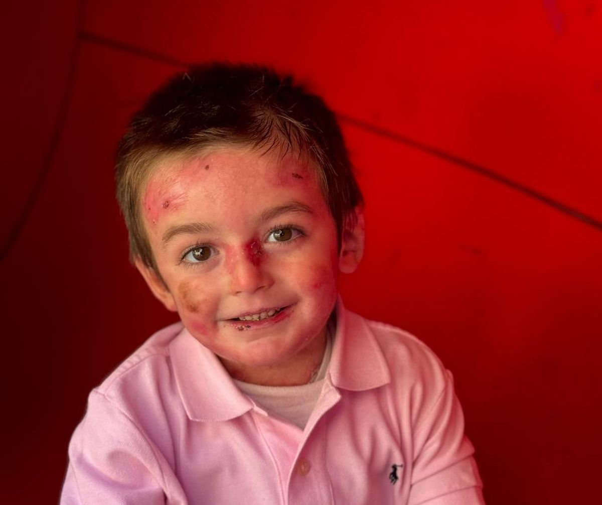 Así es la vida de Javi Gallo, el salmantino con Piel de Mariposa: colegio, extraescolares, curas y vendajes 