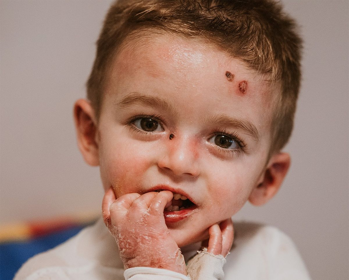 Esperanza para Javi en forma de nuevo medicamento, un salmantino de 4 años que convive con heridas abiertas por todo el cuerpo