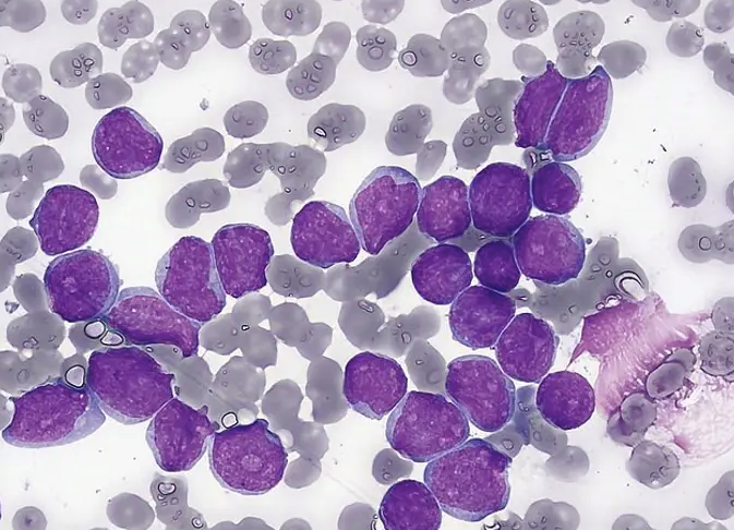 Anticiparse a la leucemia infantil en lugar de curarla: el nuevo reto del CIC de Salamanca