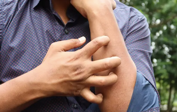 El verano dispara las alergias: Es fundamental no automedicarse para prevenir complicaciones alérgicas, aseguran expertos 