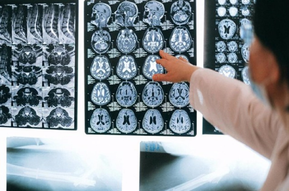 Dr. Carvalho Monteiro: La ataxia no es solo una enfermedad rara, es una realidad cotidiana para muchas personas en nuestra comunidad