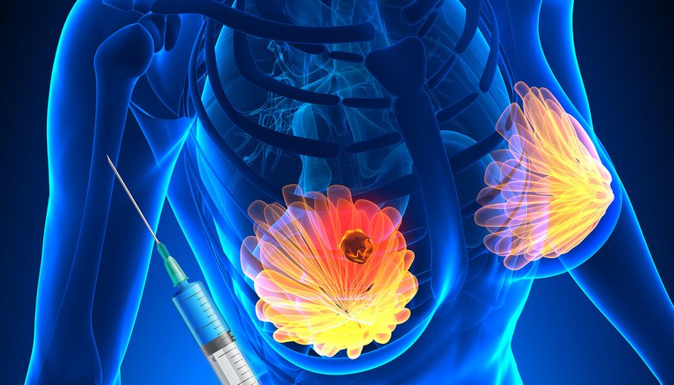 La terapia habitual con trastuzumab presenta una tasa elevada de resistencias